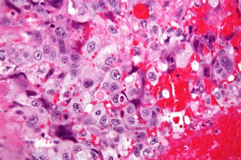 Choriocarcinoma Cytology