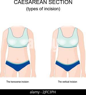 Caesarean section scar. Low vertical incision, Classical incision, Low ...