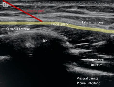 Ultrasound images in the transverse view at the midaxillary line. The ...