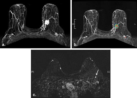 Preoperative Mri Improves Prediction Of Extensive Occult Axillary Lymph