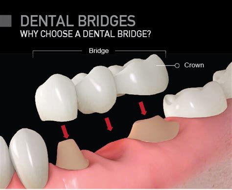 How Much Does A Bridge Cost For Teeth - Will the dental bridge change how i speak? - Download ...