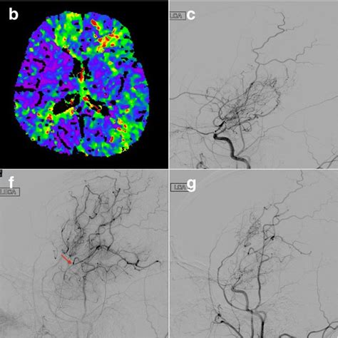 Color Coding Digital Subtraction Angiography Dsa For Moyamoya Disease