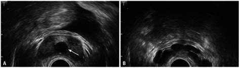 Transrectal Ultrasonography Revealed A A Midline Prostatic Cyst With Download Scientific