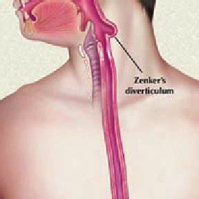 Anatomy of Zenker diverticulum. From Dis Esophagus, 1 with permission ...