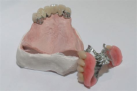 Chrome Dentures Wessex Dental Lab