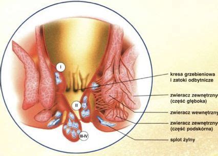 Proktologia Flebomedica Leczenie Ylak W Laserowe Operacje Ylak W