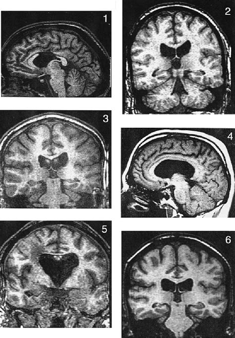 MRI scans from cases 1 – 6 showing the status of the fornix. The MRI... | Download Scientific ...