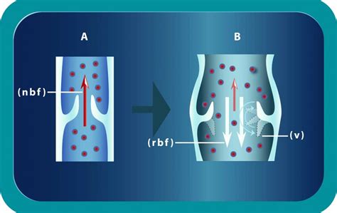 Causes And Treament Of Varicocele Georgiadis Urology