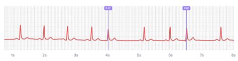 What Premature Junctional Contraction PJC Looks Like On Your Watch