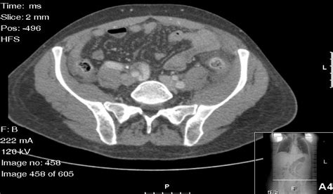 Colonoscopic Perforation Leading To A Diagnosis Of Ehlers Danlos Syndrome Type Iv A Case Report