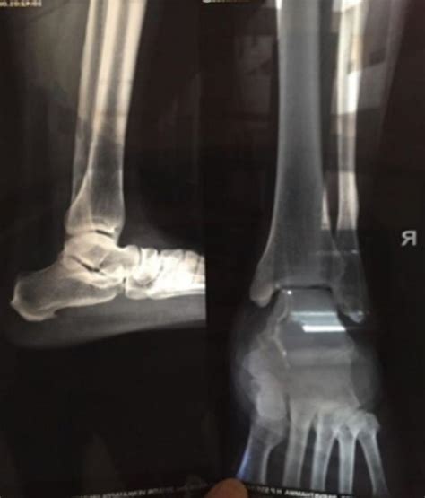 Calcaneal Spur Symptoms, Plantar Calcaneal Spur Treatment