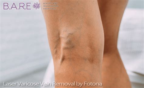 Laser Varicose Vein Removal Fotona Sp Dynamis Bare