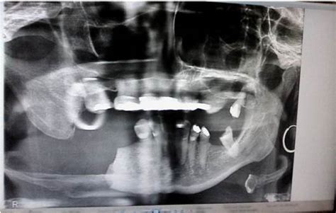 Osteonecrosis Mandibular Secundaria Al Uso De Bisfosfonatos Reporte De