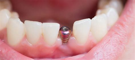 Are Dental Implants Permanent? - Brighter Smile Family Dentistry & Implants