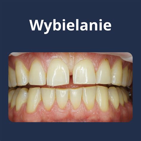 PROFILAKTYKA I WYBIELANIE Boutique Dental