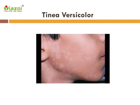 PPT - Tinea Versicolor: Symptoms, Causes, Diagnosis and Treatment PowerPoint Presentation - ID ...