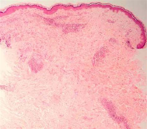 Erythema Annulare Centrifugum Histology