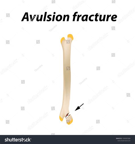 Avulsion Fracture Bone Infographics Vector Illustration Stock Vector ...