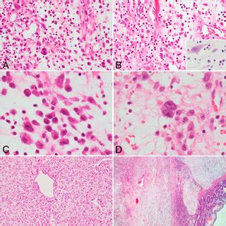 Immunohistochemistry Features Of Inflammatory Myofibroblastic Tumor