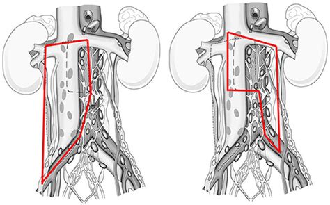 Frontiers Preservation Of Ejaculatory Function After Postchemotherapy Retroperitoneal Lymph