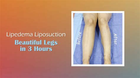 Lipedema Legs Awake Liposuction Before And After Expert Dr