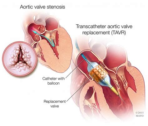 life span after aortic valve replacement - Rosamond Venegas