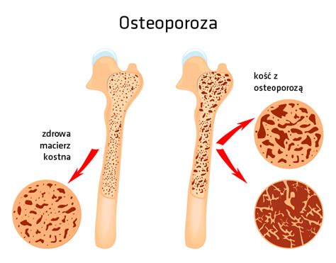 Osteoporoza Dlastawow Pl