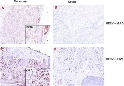 Expression Of Herv K Gag And Env In Melanoma Notes Herv K Gag A And