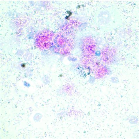 (PDF) Identification of Mycobacterium kansasii and a Mycobacterium sp ...