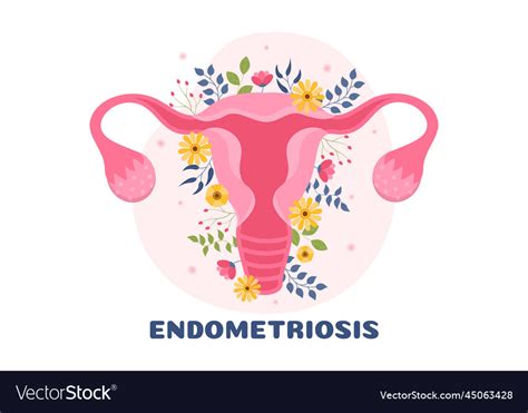 Endometriosis With Condition The Endometrium Vector Image