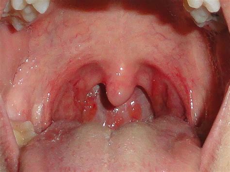 Diferencias Entre Faringitis Y Amigdalitis Sooluciona Porn Sex Picture