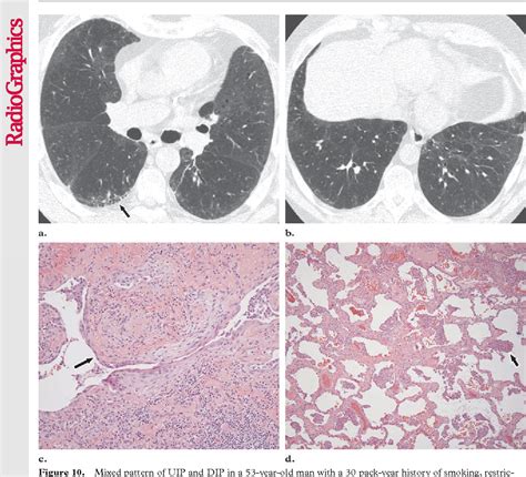 Figure From Smoking Related Interstitial Lung Disease Radiologic