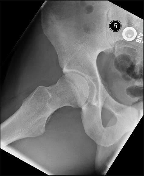 Frog Leg Lateral View Radiograph Of The Right Hip Which Was