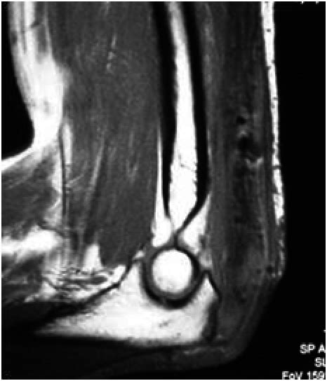 3 month MRI demonstrates intact distal triceps brachialis tendon. | Download Scientific Diagram