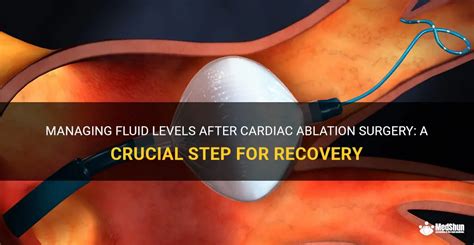 Managing Fluid Levels After Cardiac Ablation Surgery: A Crucial Step ...