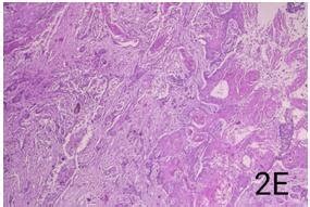 Squamous Cell Carcinoma At 40x A Infiltrating Ductal Carcinoma At