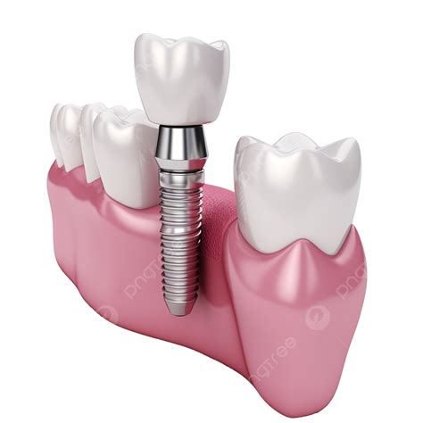 3d Gum With Dental Implant Isolated 3d Render Illustration Gum 3d