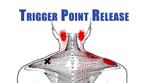 Trapezius Trigger Points