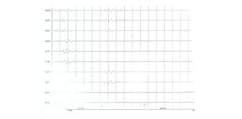 -EEG performed some hours after birth. Note that it is isoelectric ...