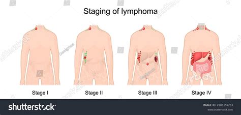 Stage Lymphoma Cancer Lymphatic System Signs Stock Vector (Royalty Free ...