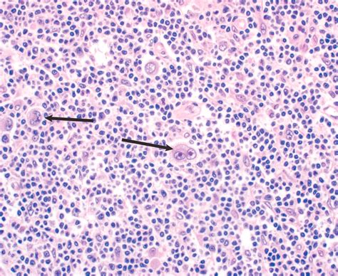 Pediatric Head And Neck Neoplasms Clinical Tree