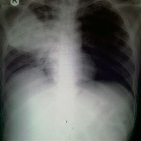 Multilobar collapse showing partial collapse of right middle lobe and... | Download Scientific ...