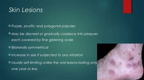 Types Of Oral Lichen Planus