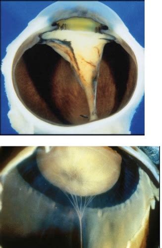 Abnormal Ocular Conditions L And L Vitreous And Retina Part