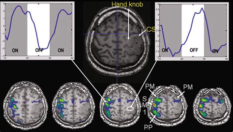 Bold Fmri And Dti Artifacts Tips And Tricks Radiology Key