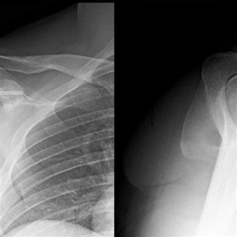 An Anteroposterior AP And Scapular Y Radiograph Of A Right Shoulder