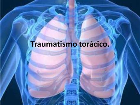 Traumatismo Toracico