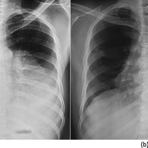 A Preoperative Chest X Ray Shows Huge Mass Occupying Both Hemithorax