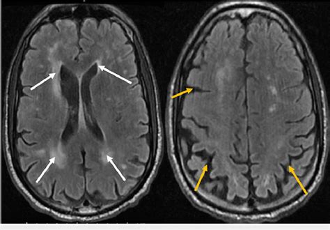 Magnetic Resonance Imaging Of The Brain Showing Multifocal Acute Download Scientific Diagram