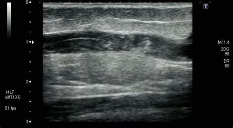 Ultrasound of left anterior tibial vein. Longitudinal view of anterior ...